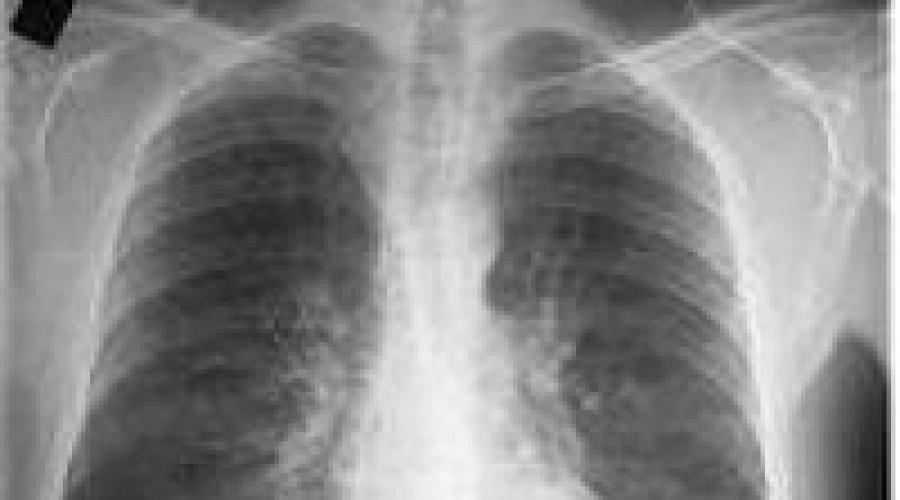 Wie man eine Bronchitis im Röntgenbild erkennt und wie man sie behandelt.  Was ist ein Bild einer Bronchitis? Was ist ein Bild einer Bronchitis?
