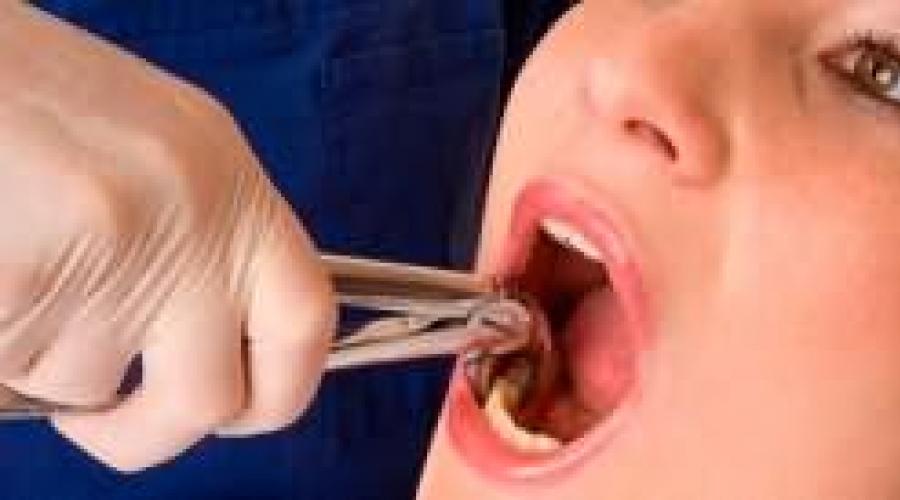 К чему снится вырванный зуб, рвать зуб себе самому или другому? Основные толкования, к чему снится вырывать зубы самому себе. Вырвать гнилой зуб во сне