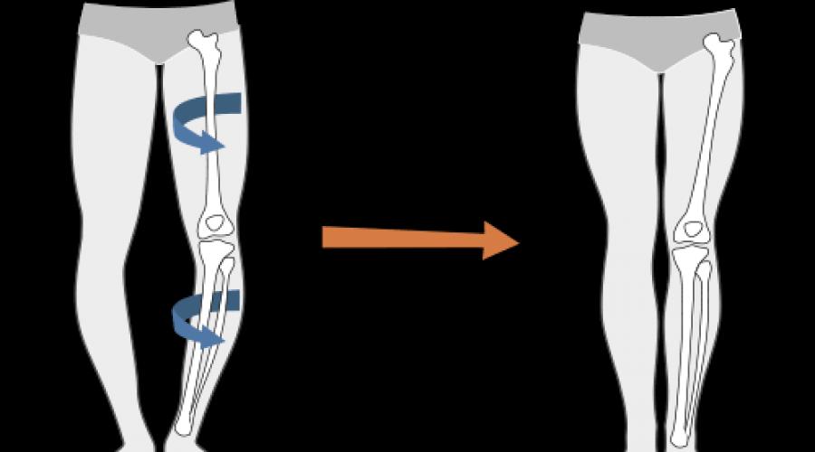 Как исправить форму ног с помощью подплечниками. Как исправить кривые ноги в зависимости от сложности ситуации