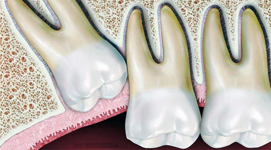 Wie kann man einen extrahierten Zahn wiederherstellen?  Effektive Methoden zur Zahnrestaurierung