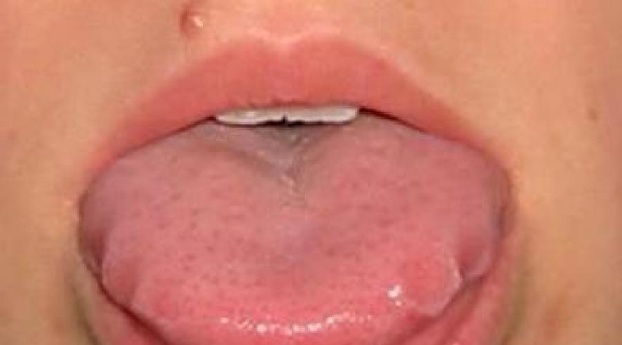 Die Zunge ist taub und kribbelt.  Taubheit der Zunge (Zungenspitze) – Ursachen, Diagnose und Behandlung