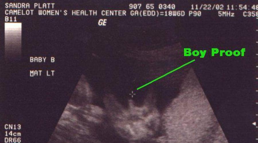 Ultraschalluntersuchungen können falsche Angaben zum Geschlecht machen.  Kann eine Ultraschalluntersuchung das Geschlecht eines Kindes verfälschen?