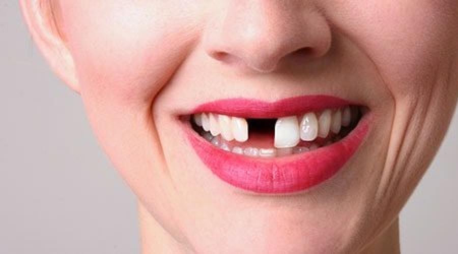 Rêves de dents.  Pourquoi rêver de Fausses Dents ?  Interprétation des rêves Dents chez un enfant