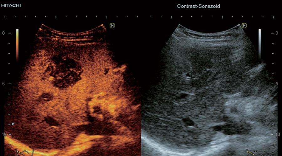 Sang après échographie de l'utérus.  Pertes vaginales sanglantes et saignements en gynécologie