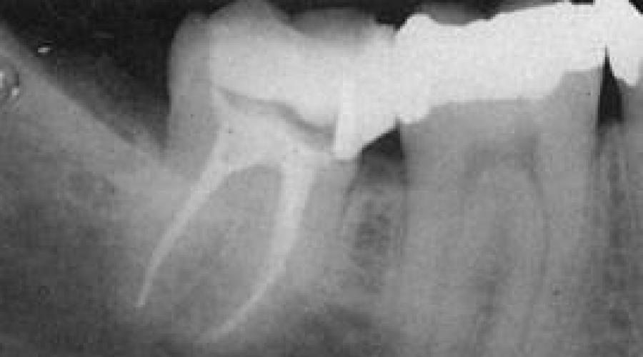 Röntgenforschungsmethoden in der Zahnheilkunde.  Zusammenfassung: Methoden der Strahlenforschung in der Zahnheilkunde