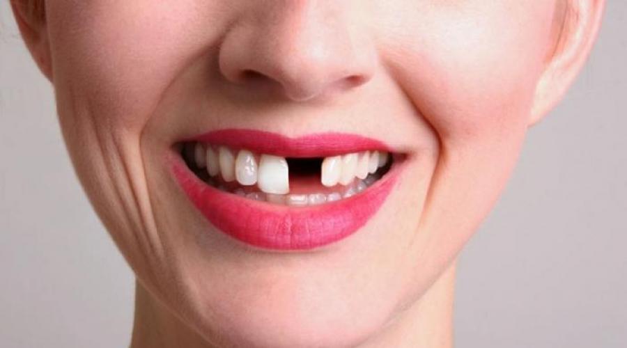 Träumen Sie davon, dass Zähne ausfallen, ohne zu bluten.  Warum träumen Sie von einem verlorenen Zahn – die wahrsten Traumdeutungen