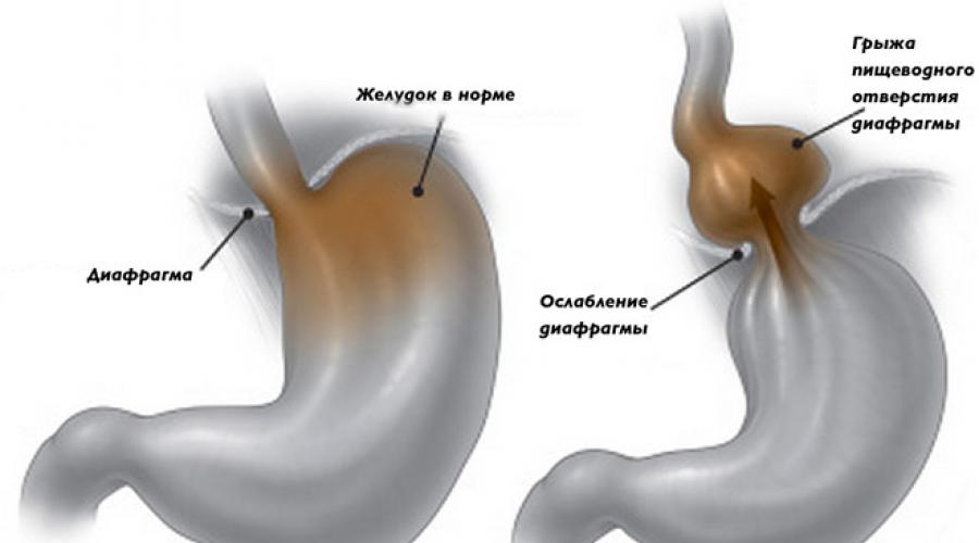Oesophagite érosive par reflux de type a.  Oesophagite par reflux: symptômes et traitement avec des pilules, un régime et des remèdes populaires