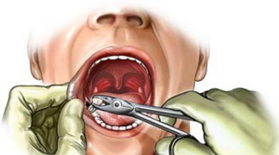 Taubheitsgefühl der Zunge: Ursachen eines alarmierenden Symptoms.  Taubheitsgefühl (Parästhesie) der Zunge