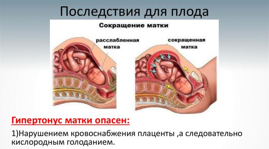 L'abdomen devient raide pendant la grossesse.  La gymnastique, la nutrition et les médicaments aideront-ils pendant la grossesse, si l'estomac devient pierreux et dur, qu'est-ce que cela signifie et y a-t-il un risque