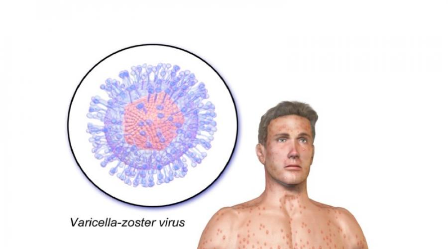 Varicella zoster igg positiv, was bedeutet das?  Varicella-Zoster-Virus-IgM (im Blut), (Varicella-Zoster-Virus-IgM, Anti-VZV-IgM, IgM-Antikörper gegen Varicella-Zoster-Virus)