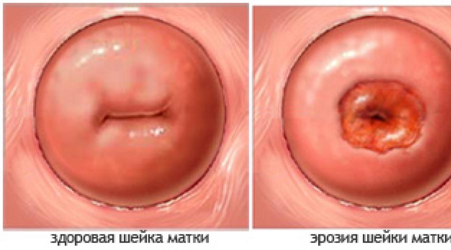 Are loc eroziunea colului uterin la nulipare.  De ce apare eroziunea cervicala si aceasta afectiune este normala pentru cele care inca nu au nascut?  Tratament chirurgical: este necesară intervenția chirurgicală?