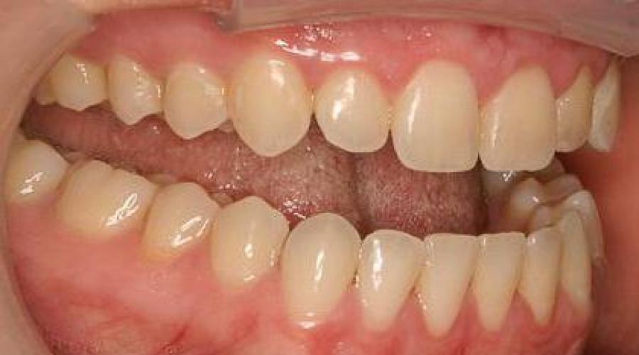 Was gehört zum Parodontium?  Blutversorgung der Zahnfleischschleimhaut