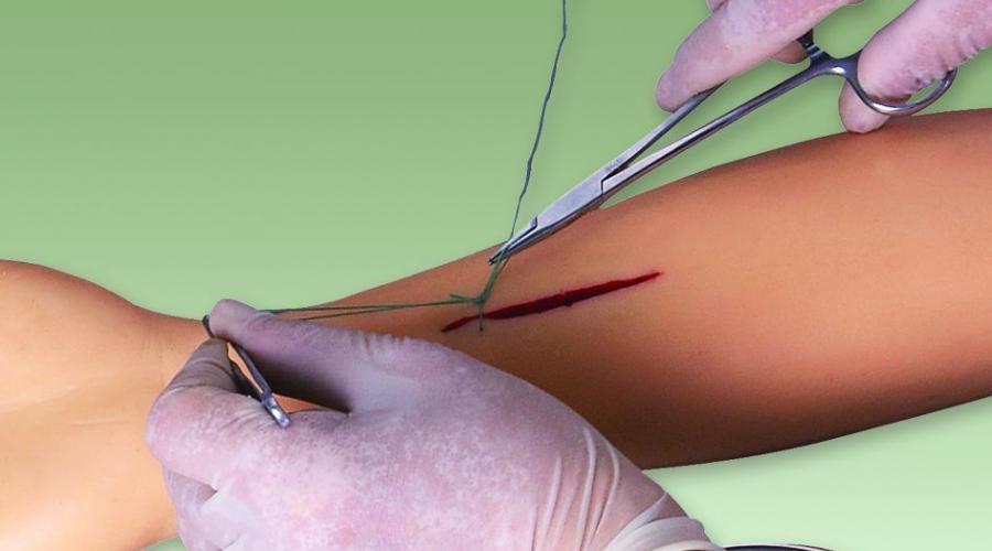 Sutures chirurgicales : types, technique.  Points de suture après l'accouchement : matériaux et technologies